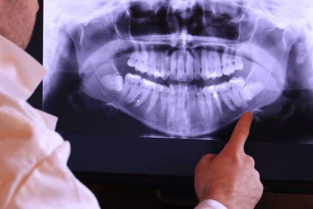 Best Emergency Wisdom Tooth Extraction in Glenville, WV